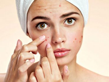 Trattamento dell’acne
